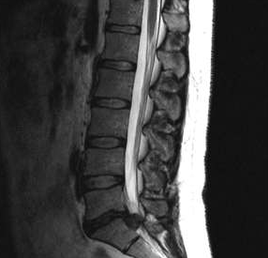 Opciones de diagnóstico para osteocondrosis lumbar