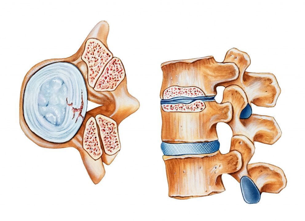 La osteocondrosis de la región del cuello uterino conduce a la destrucción de los discos intermedios del intermedio