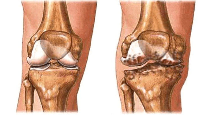 Articulación sana y osteoartritis de la articulación de la rodilla