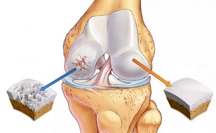 Cartílago saludable y osteoartritis de la articulación