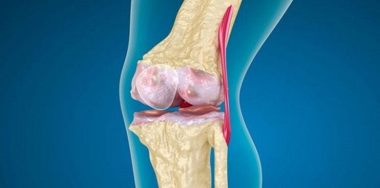 Daño a la articulación de la rodilla por osteoartritis