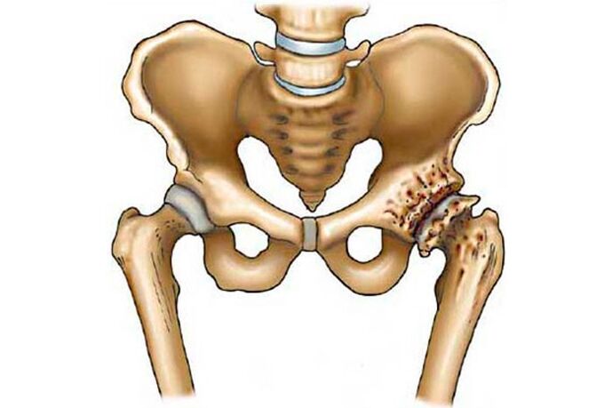 Osteoartritis de la articulación de la cadera