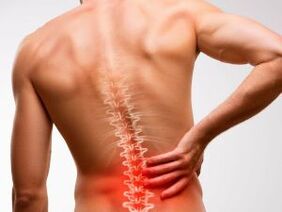 Dolor lumbar debido a la osteocondrosis.